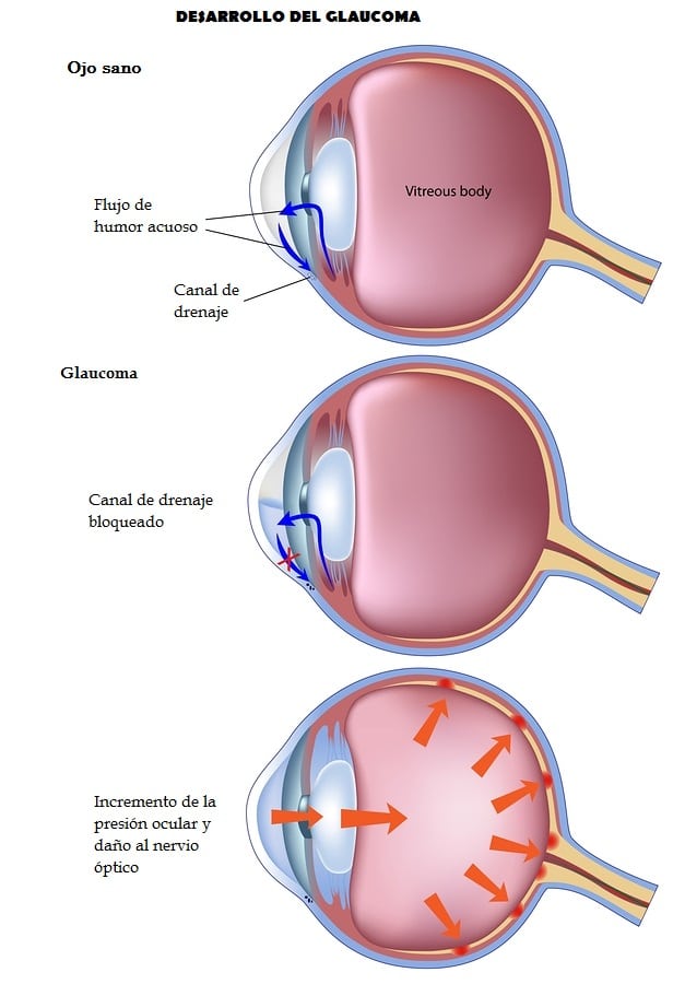 que-es-la-glaucoma-my-xxx-hot-girl